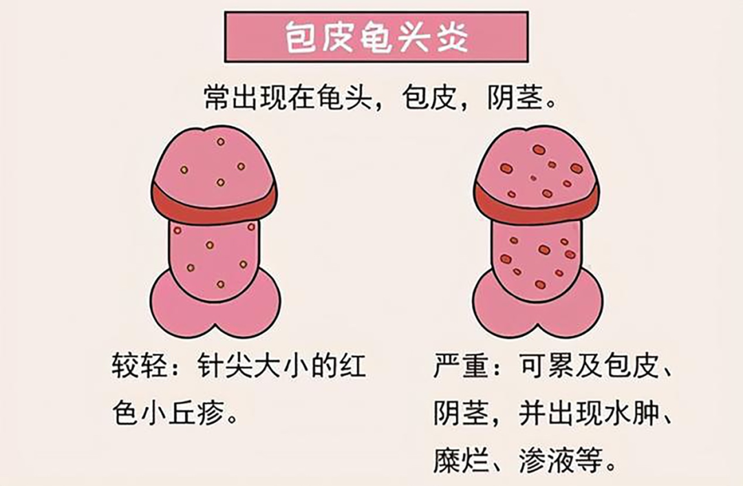 龟头炎，<a class='link_keywords' href='http://nanke.nkyyy.com/'>韶关男科医院</a>，<a class='link_keywords' href='http://nanke.nkyyy.com/'>韶关圣亚医院</a>