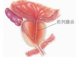 前列腺炎