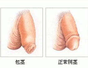 割包皮