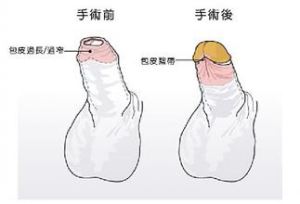 包皮手术