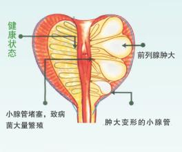 前列腺炎
