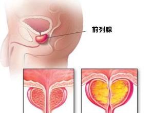 前列腺炎