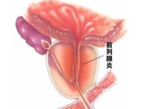 前列腺炎