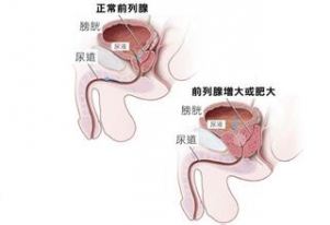 前列腺问题