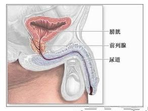 前列腺炎